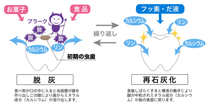 虫歯になるのはどうして