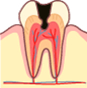 虫歯の後期