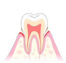 軽度（初期）歯周炎