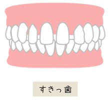 すきっ歯